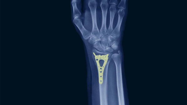 X-ray of a hand showing an osteosynthesis plate